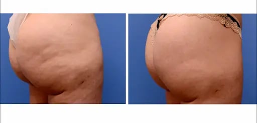 Before and After Results