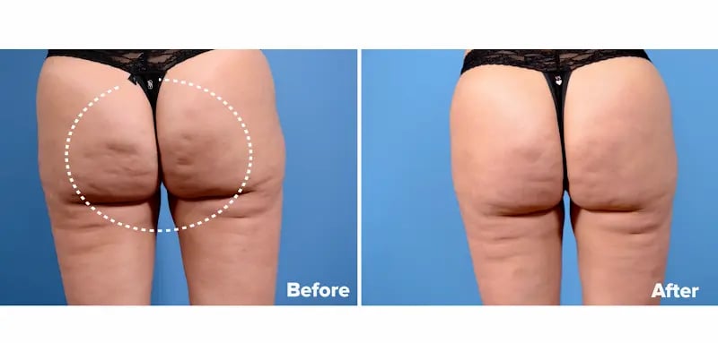 Before and After Results